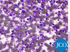 diffuse large B-cell lymphoma