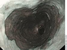 Endoscopy image of Barrett's esophagus